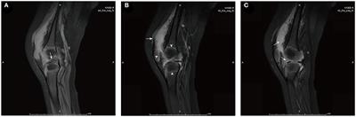Case report: Acinetobacter baumannii septic arthritis in an immunocompetent infant